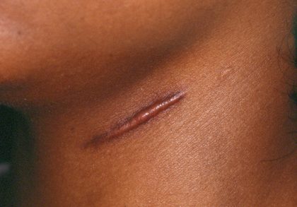 Hypertrophic scar, from the lecture slides