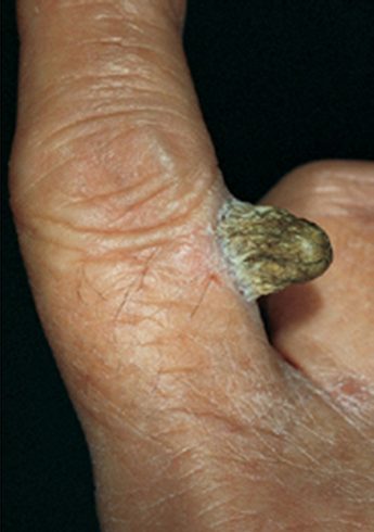 Cutaneous horn, from the lecture slides