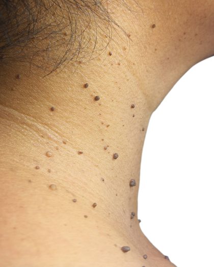 Acrochordon (skin tag), from the lecture slides