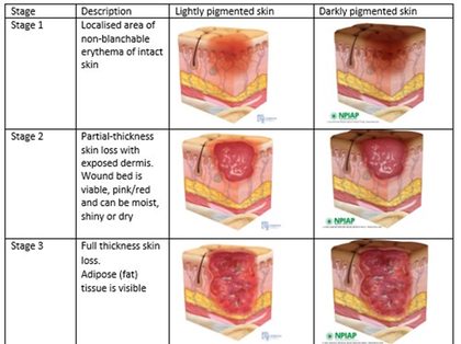 Pressure injury (pressure ulcer), from the lecture slides
