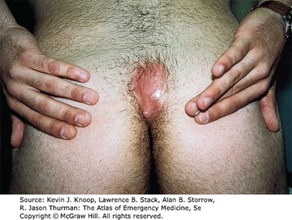 Pilonidal cyst, from the lecture slides