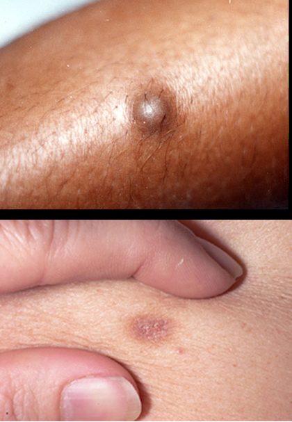 Dermatofibroma, from the lecture slides