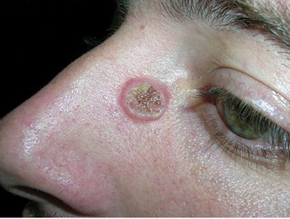 Keratoacanthoma, from the lecture slides