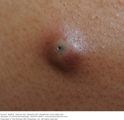 Epidermoid (epidermal) cyst, from the lecture slides