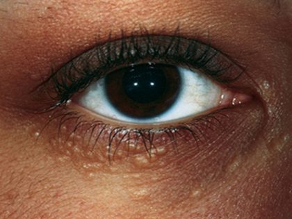 Syringoma, from the lecture slides