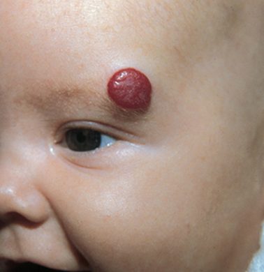 Infantile hemangioma, from the lecture slides