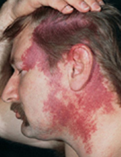 Nevus flammeus (port-wine stain), from the lecture slides