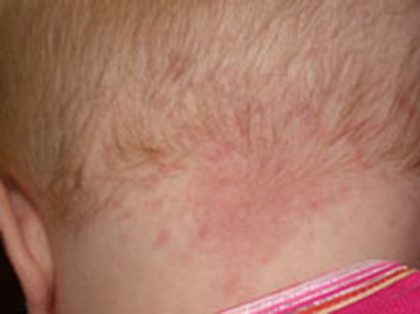 Nevus simplex (stork bite), from the lecture slides