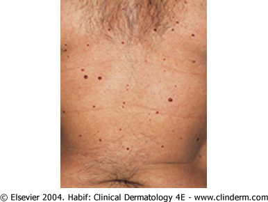 Cherry angioma, from the lecture slides