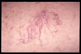 Telangiectasia, from the lecture slides