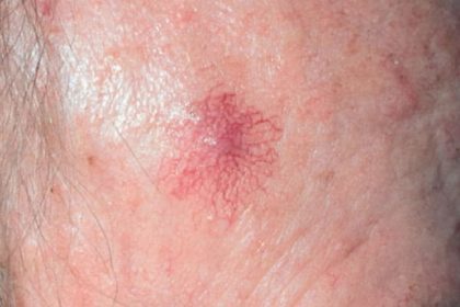 Nevus araneus (spider angioma), from the lecture slides