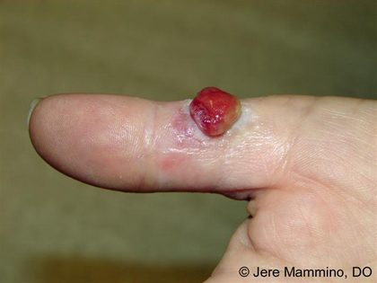 Pyogenic granuloma, from the lecture slides