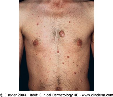 Neurofibromatosis type 1, from the lecture slides
