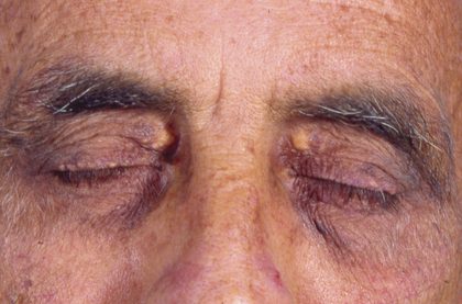 Xanthelasma, from the lecture slides