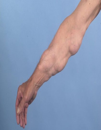 Lipoma, from the lecture slides