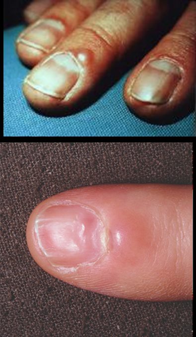 Digital mucous cyst, from the lecture slides
