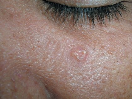 Sebaceous hyperplasia, from the lecture slides