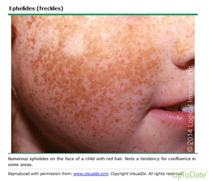 Ephelides (freckles), from the lecture slides