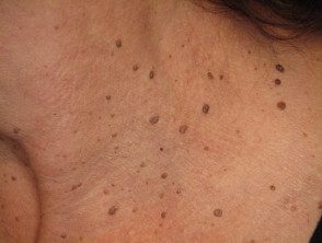 Dermatosis papulosa nigrans, from the lecture slides
