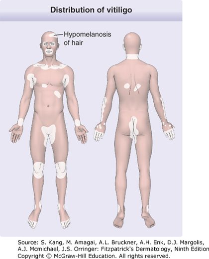 Vitiligo, from the lecture slides