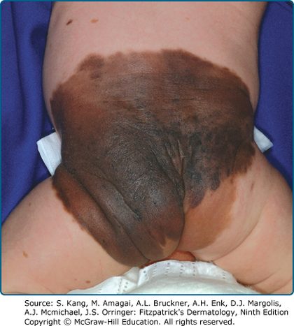 Congenital melanocytic naevus, from the lecture slides