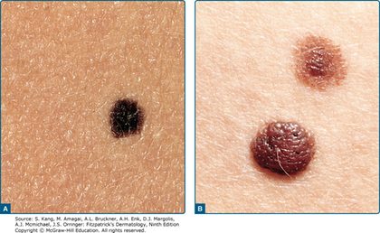 Common acquired melanocytic naevus (mole), from the lecture slides