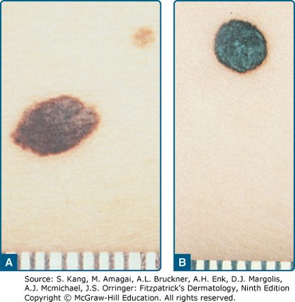 Pigmented spindle cell naevus (Reed), from the lecture slides