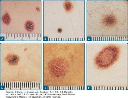 Dysplastic melanocytic naevus, from the lecture slides