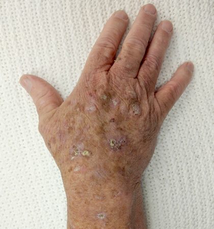 Actinic keratosis, from the lecture slides