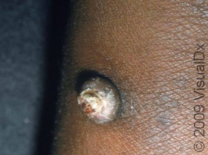 Squamous cell carcinoma, from the lecture slides