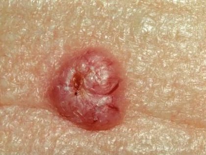 Basal cell carcinoma - nodular, from the lecture slides
