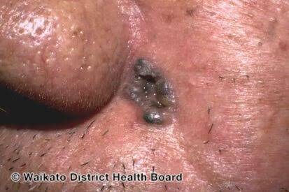 Basal cell carcinoma - pigmented and morpheaform, from the lecture slides