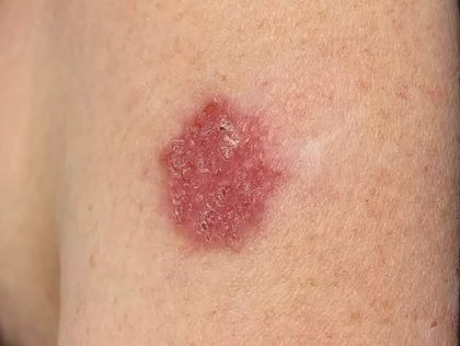 Basal cell carcinoma - superficial, from the lecture slides