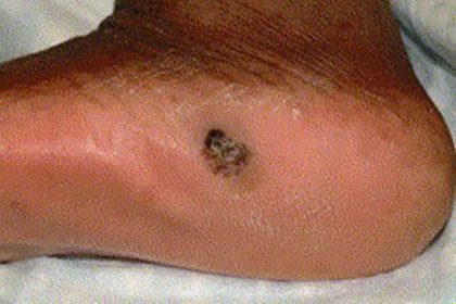 Malignant melanoma, from the lecture slides