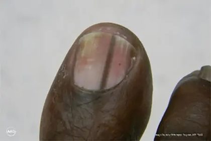 Nail unit melanoma, from the lecture slides