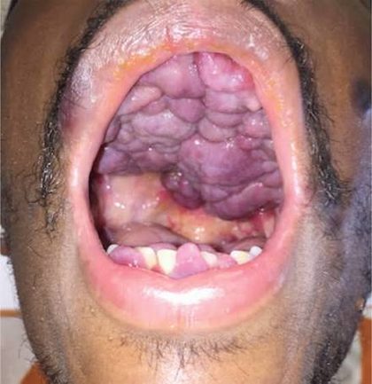 Kaposi sarcoma, from the lecture slides