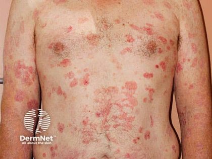 Cutaneous T-cell lymphoma (mycosis fungoides), from the lecture slides