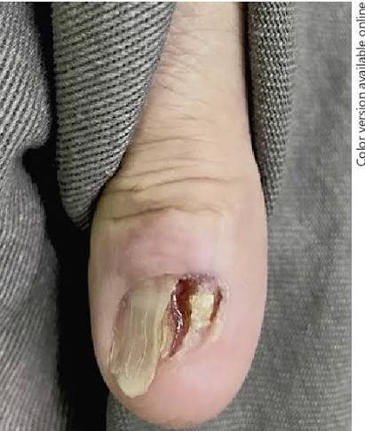 Nail unit squamous cell carcinoma / Bowen disease, from the lecture slides