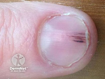 Glomus tumor and the benign nail tumors, from the lecture slides