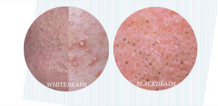 Comedonal: closed comedones (whiteheads) and open comedones (blackheads). Non-inflammatory. Slide 13.