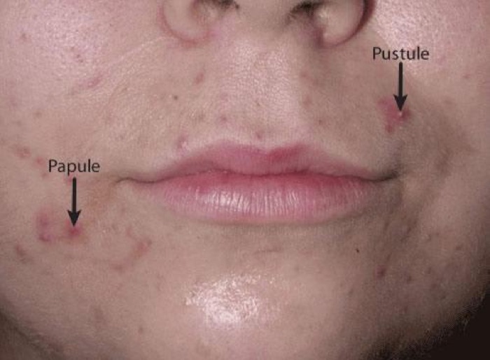 The deck's labeled papule and pustule - the inflammatory lesions that move a patient off the comedonal rung. Slide 11.