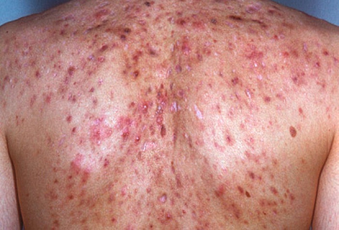 Severe inflammatory and nodular disease, the band where isotretinoin monotherapy becomes an option. Slide 13.