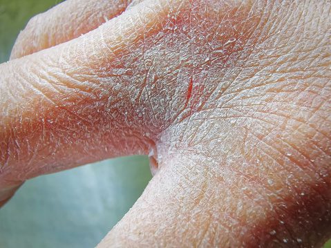 Chronic-stage hands: thickened, fissured, lichenified skin with accentuated skin markings. Slide 46.