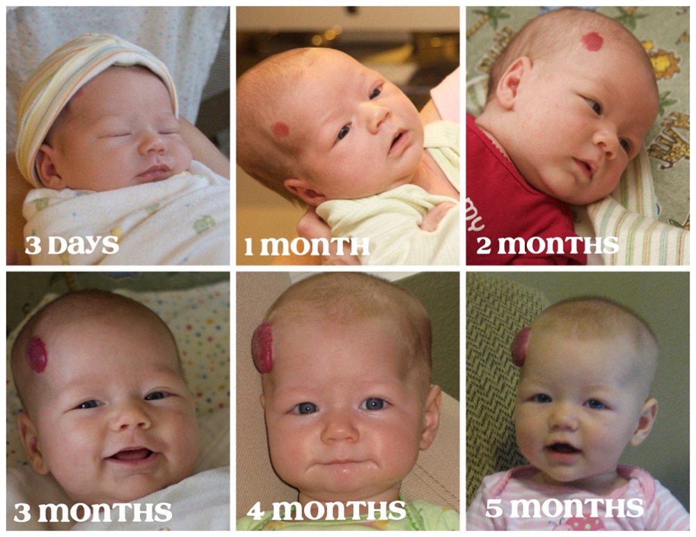 The proliferative phase in one infant from 3 days to 5 months - the growth curve the parents are being counseled about. Slide 68.