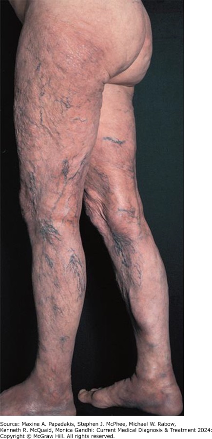 Stage 3: acrodermatitis chronica atrophicans - atrophic, translucent skin with veins showing through. Slide 76, the picture that follows the Stage 3 slide.