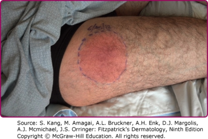 Stage 1: erythema migrans, with the expanding ring and central clearing. Slide 73.