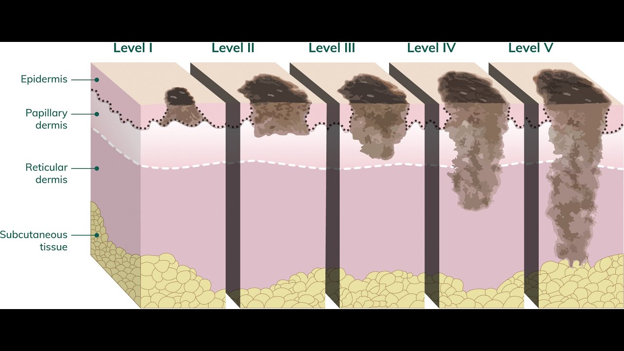 Levels I-V against epidermis, papillary dermis, reticular dermis and subcutaneous tissue. Slide 50 - the entire slide is this image.