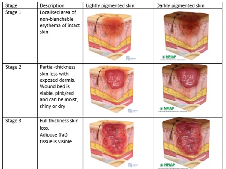 Stages 1-3, each shown in lightly and darkly pigmented skin. Slide 33 - this table is the entire slide, as an image.