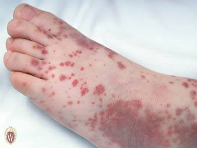 Blood deposits - the pair separated by millimeters rather than by a centimeter. Slide 15.