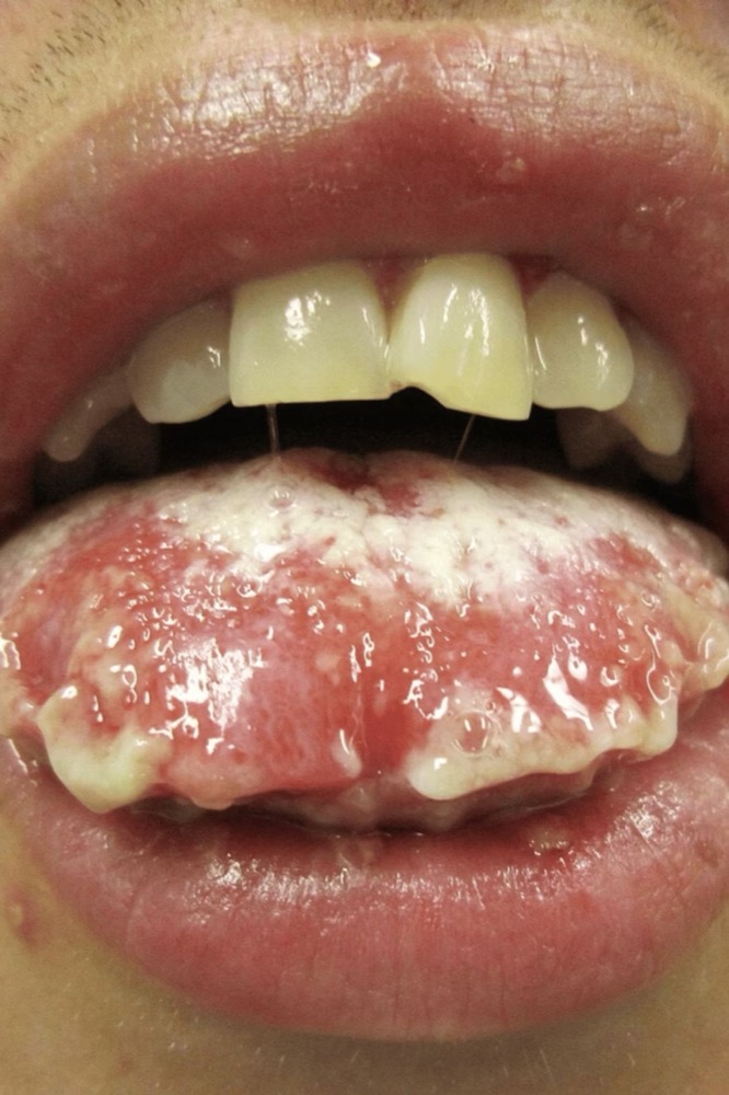 Mucosal erosions and hemorrhagic crusting of the lips - present across the spectrum, so it does not tell you which end you are at. Slide 80.